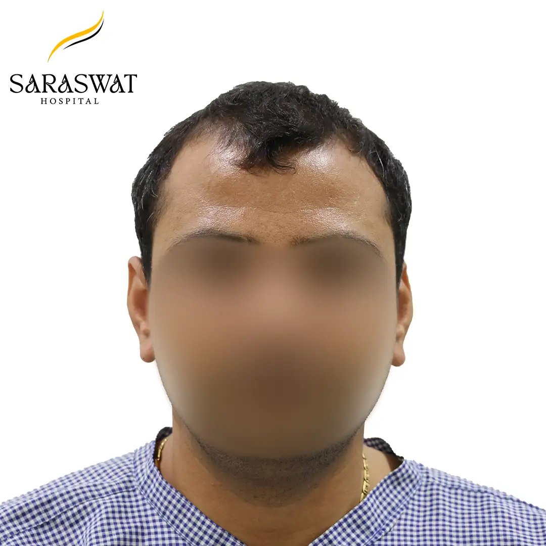 Front FUE Hair Transplant Result Before Procedure
