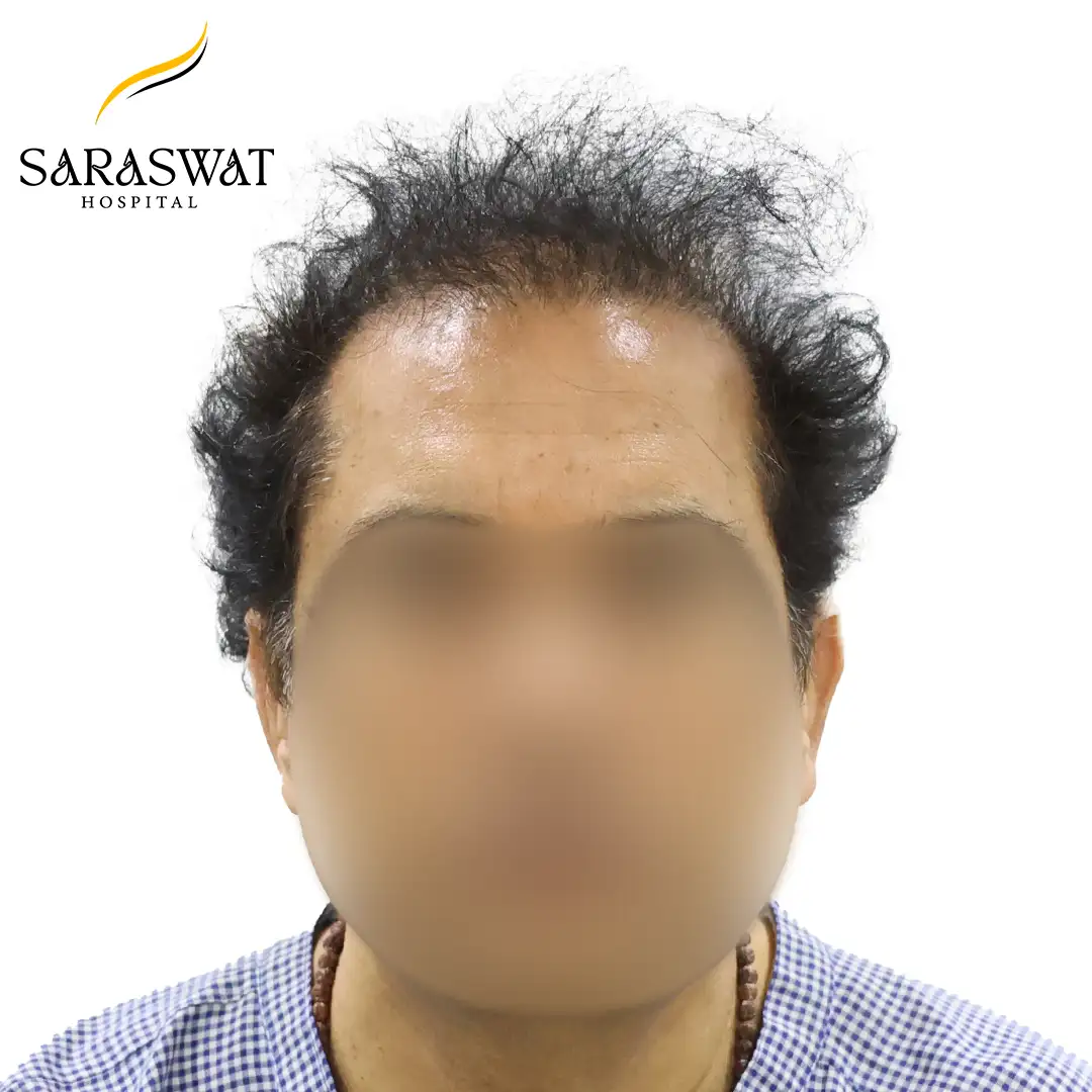 FUE Hair Transplant Result
