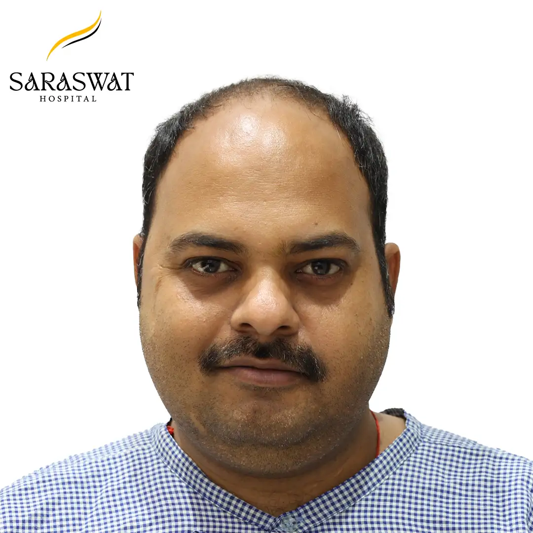 Front FUE Hair Transplant Result Before Procedure