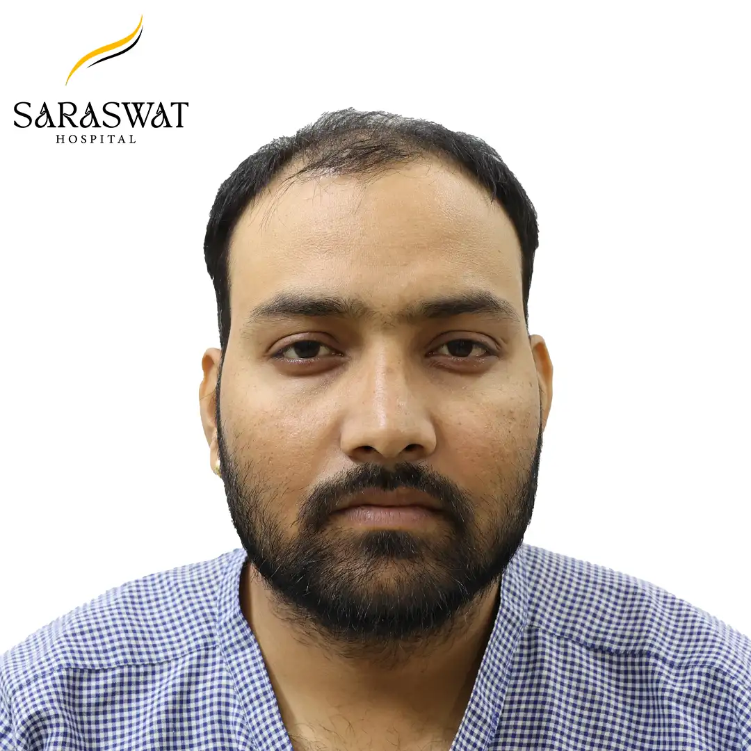 Front FUE Hair Transplant Result Before Procedure