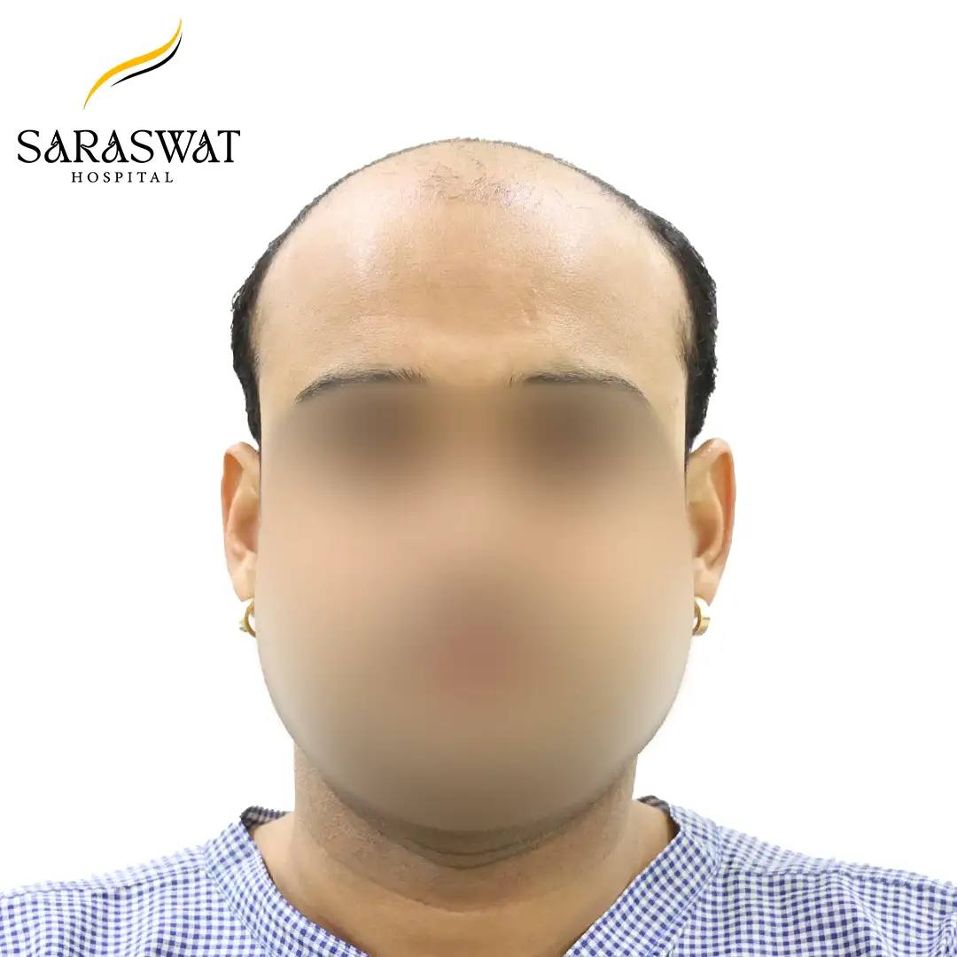 Front FUE Hair Transplant Result Before Procedure