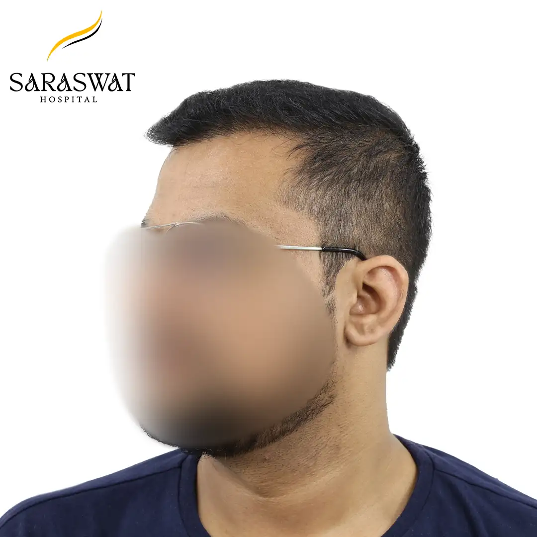 Hair Transplant Before After