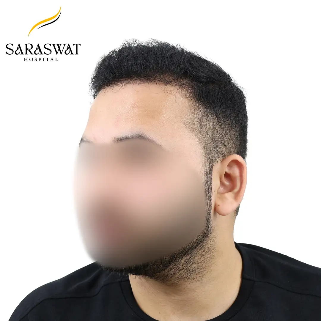 Hair Transplant Before After