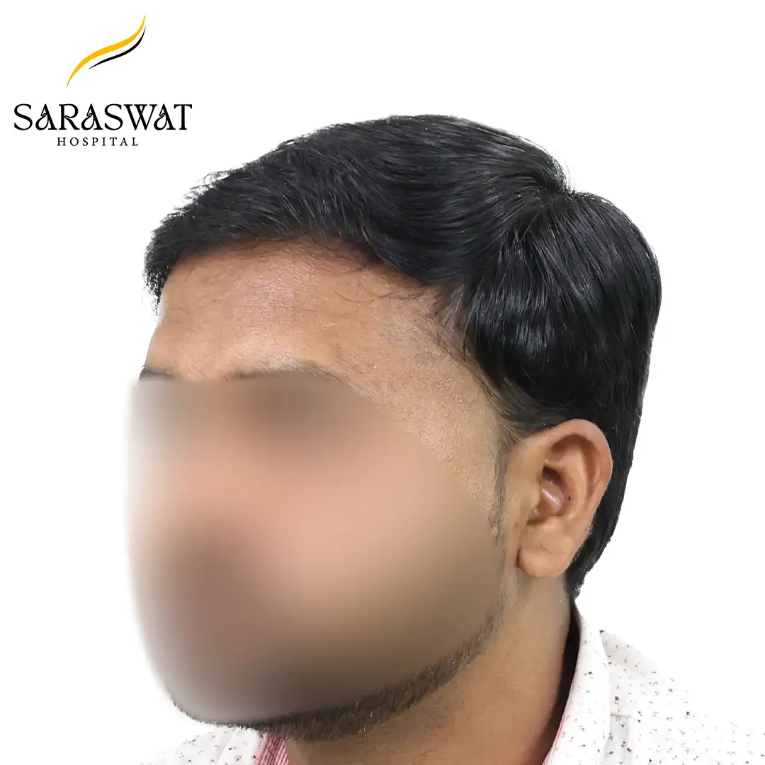 FUE Hair Transplant
