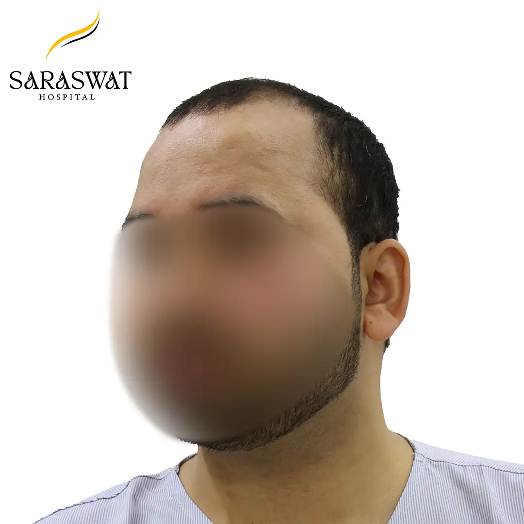 Hair Transplant Before After