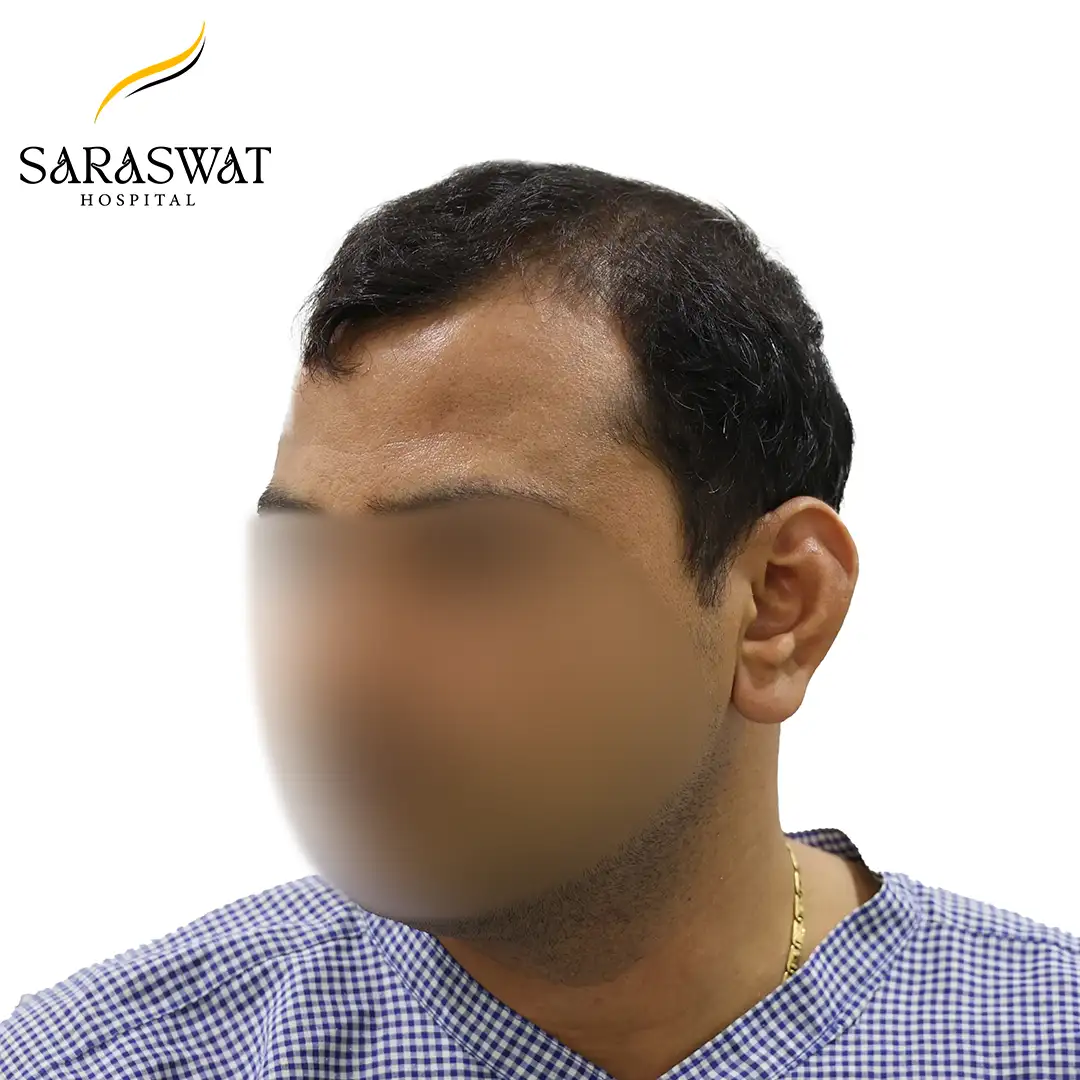 45 Degree Right FUE Hair Transplant Result Before Procedure