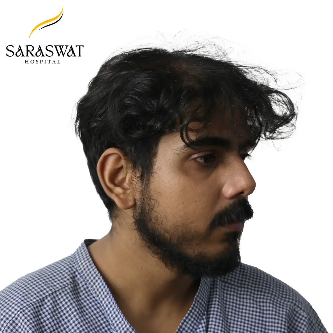 45 Degree Right FUE Hair Transplant Result Before Procedure