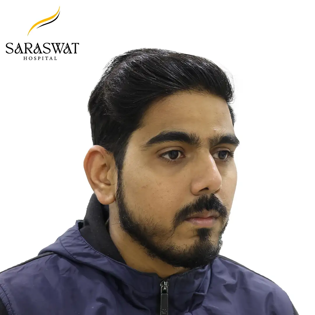 45 Degree Right FUE Hair Transplant Result After Procedure