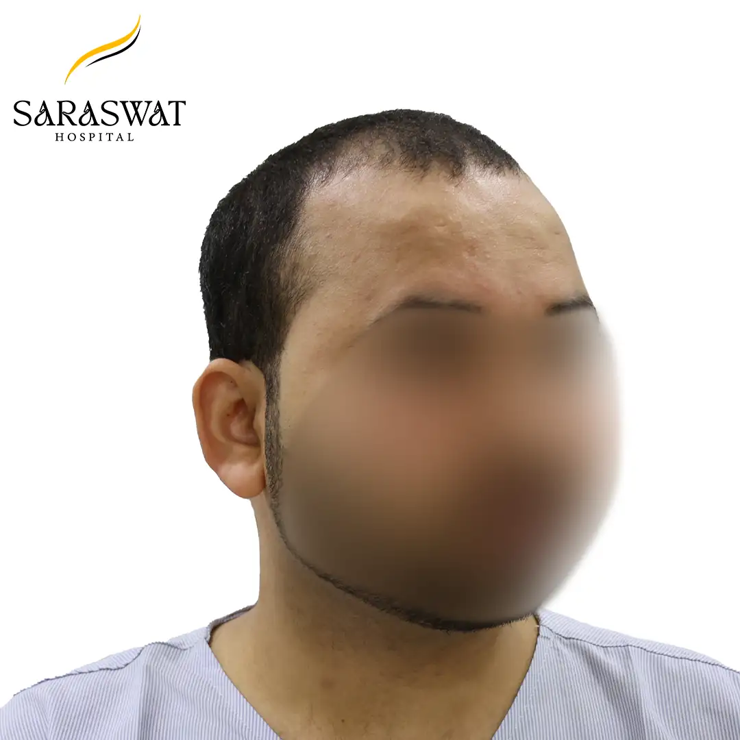 Hair Transplant Before After