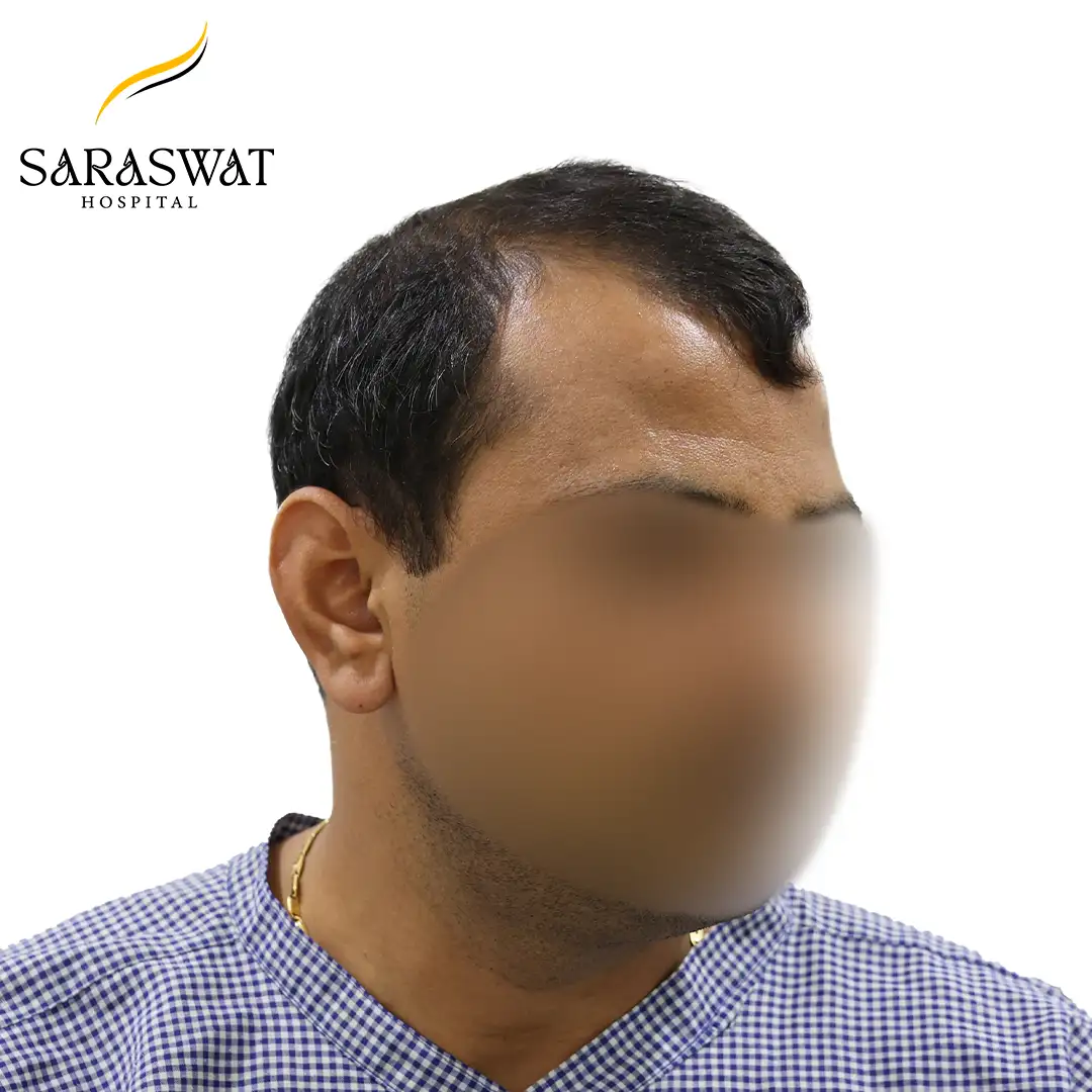45 Degree Left FUE Hair Transplant Result Before Procedure