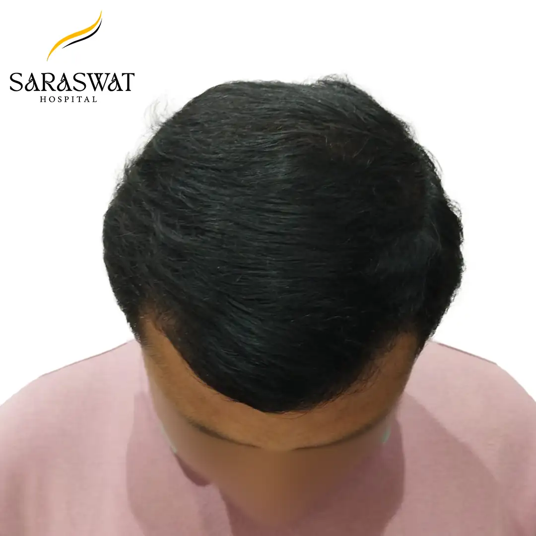 Top FUE Hair Transplant Result After Procedure