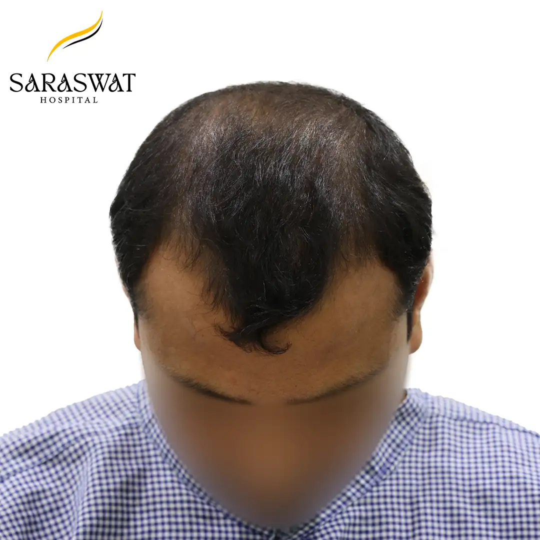 Top FUE Hair Transplant Result Before Procedure