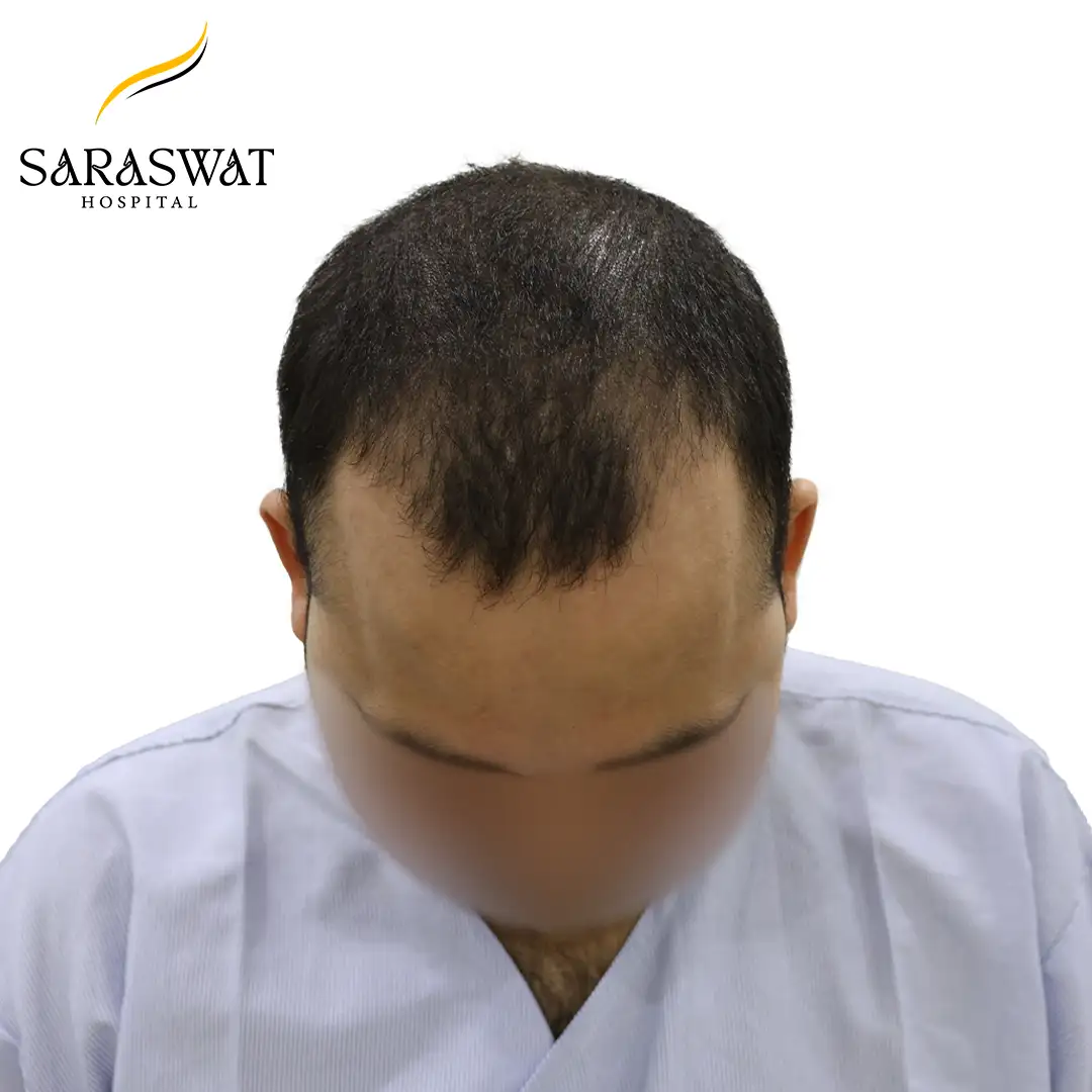 Top FUE Hair Transplant Result Before Procedure