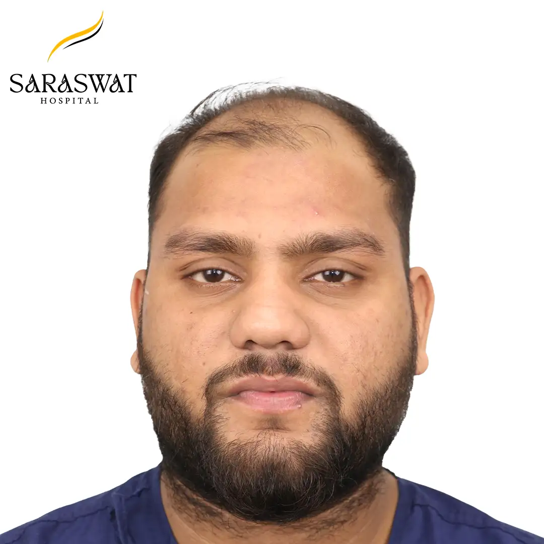 Front FUE Hair Transplant Result Before Procedure