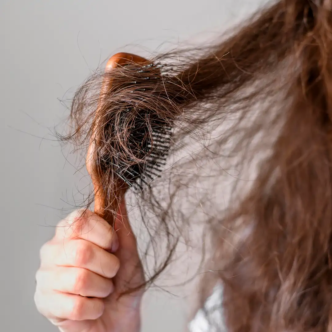 Hair Loss Treatment in Agra, India | Saraswat Hospital