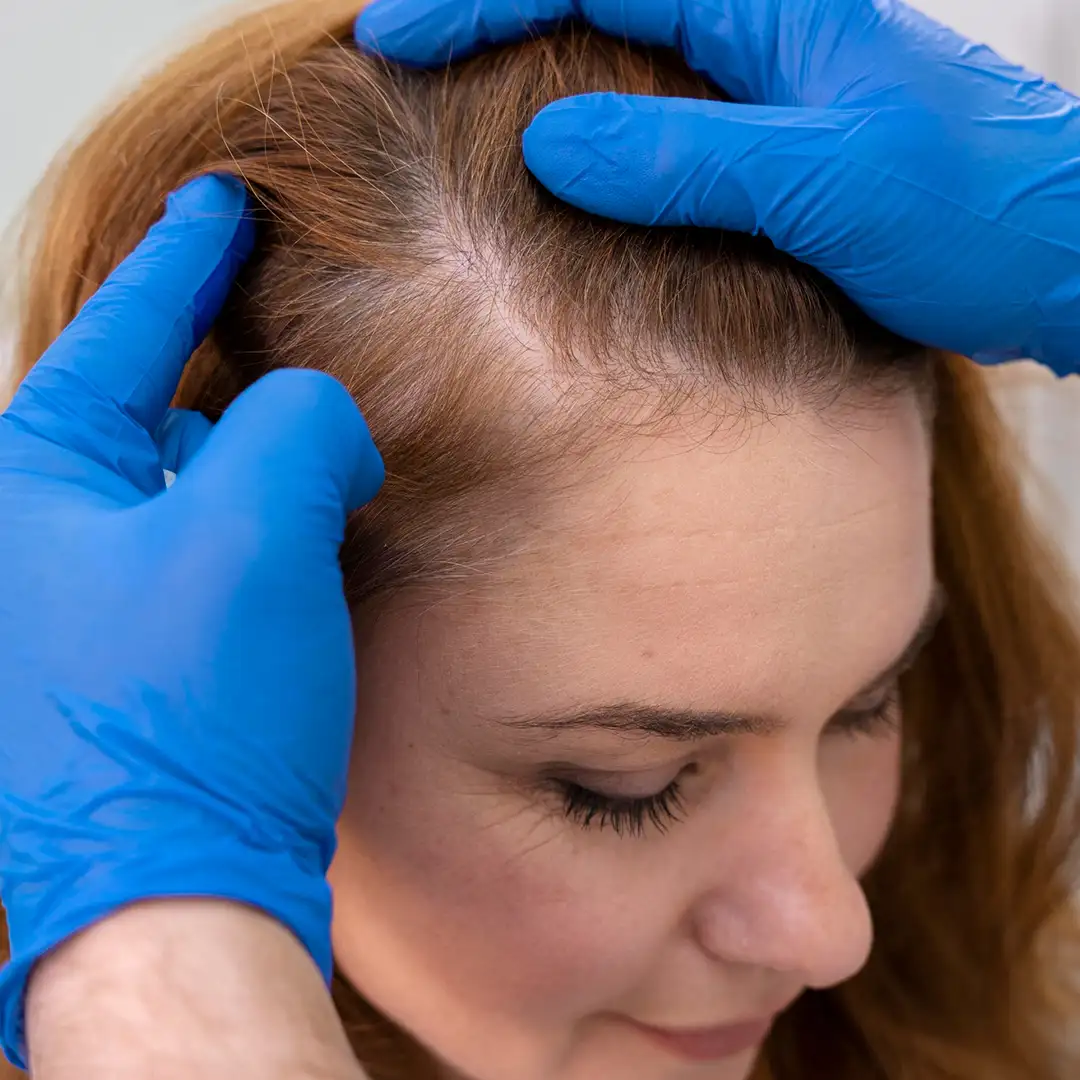 Long Hair Transplant Clinic in India