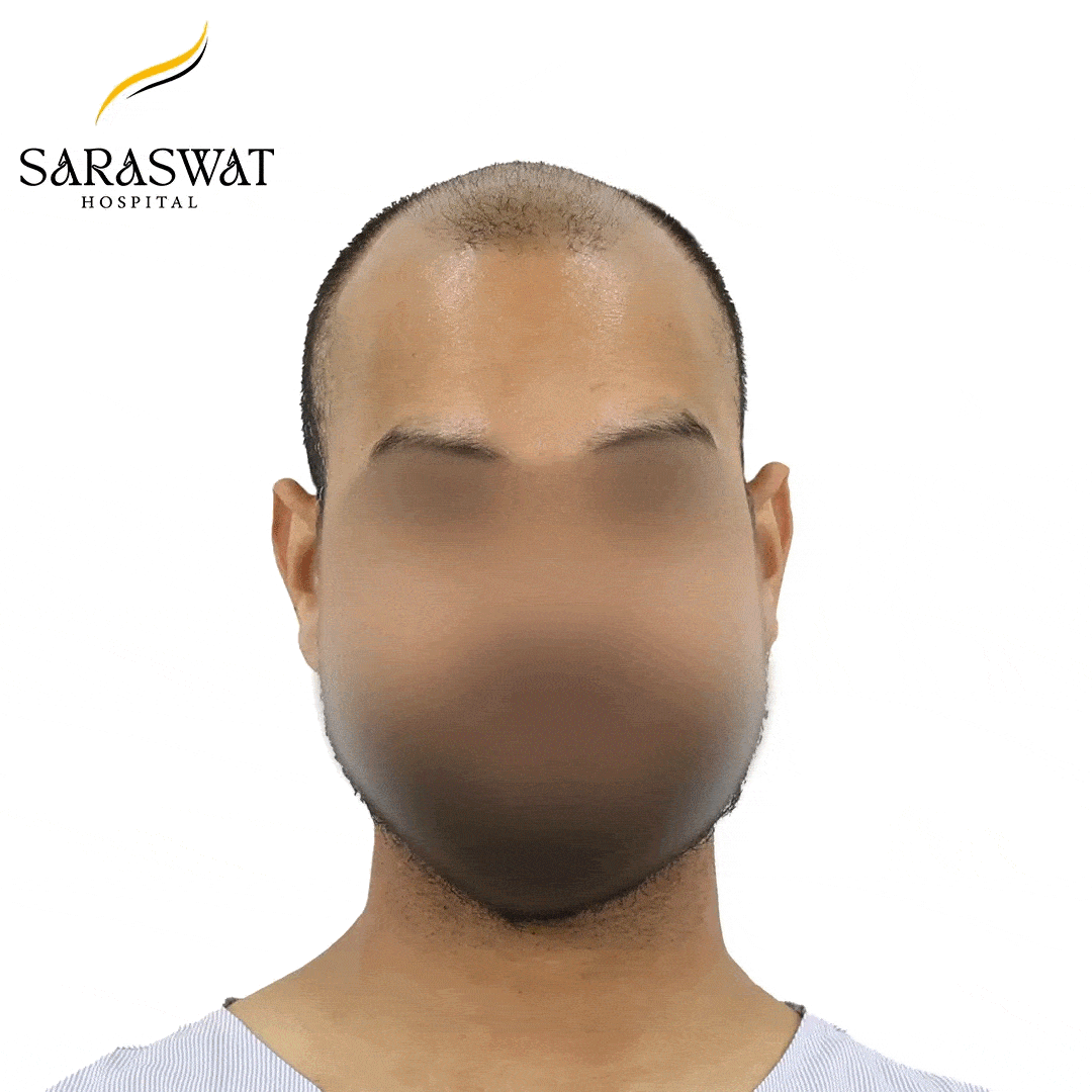 Hair Transplant Before and After Result