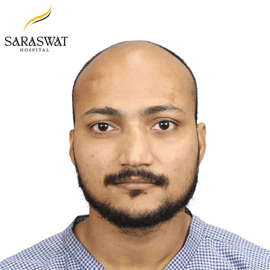 Hair Transplant Before and After Results