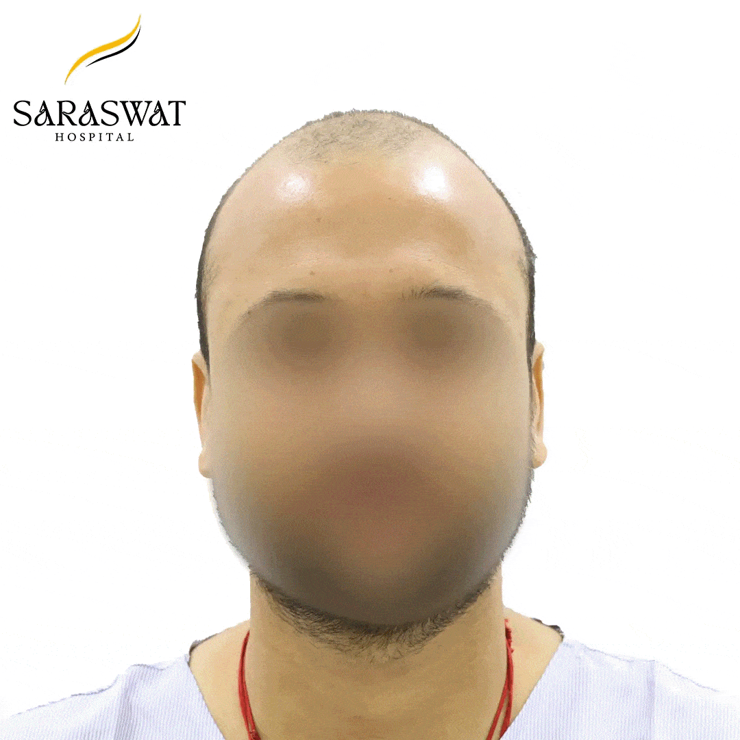 Hair Transplant Before and After Results