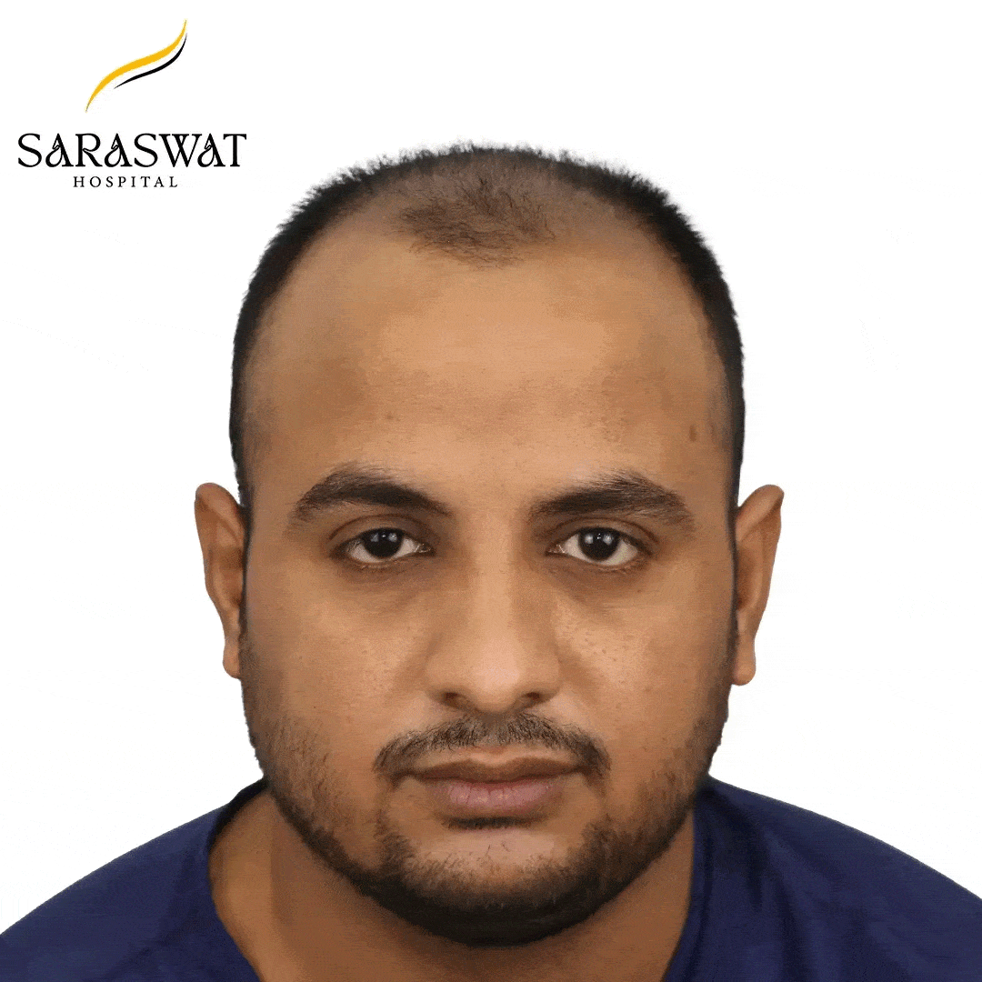 Hair Transplant Before and After