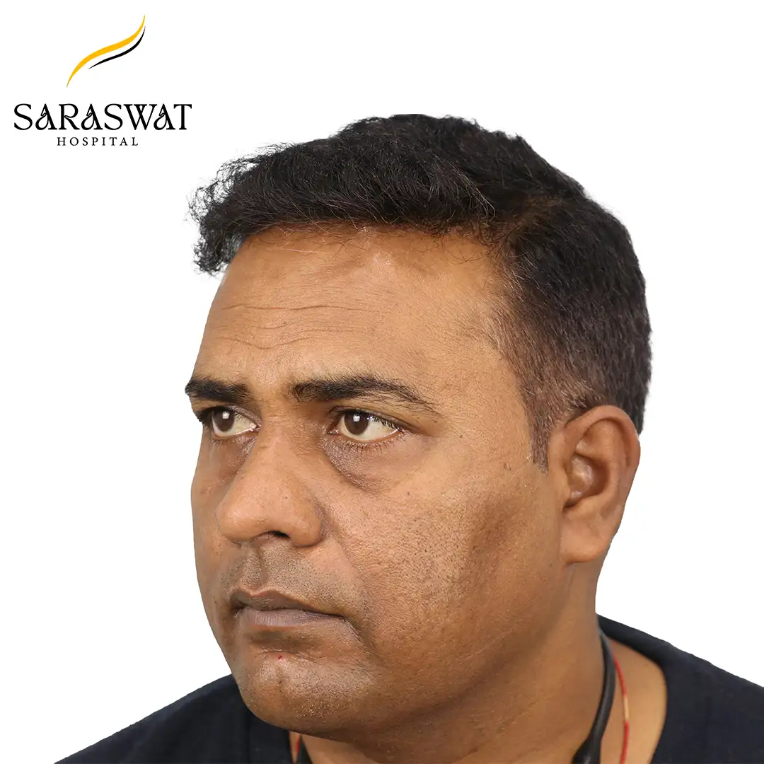 Hair Transplant Results
