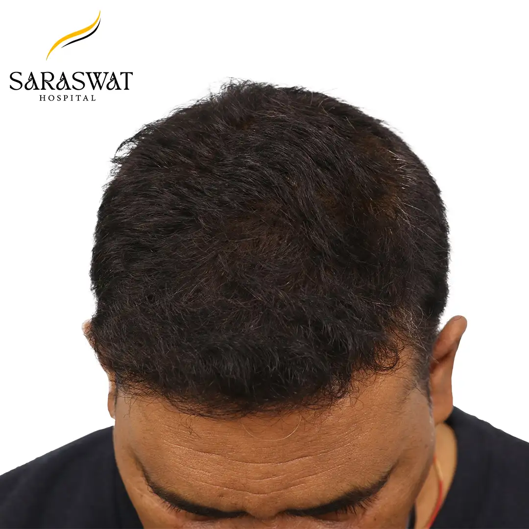 Hair Transplant Results