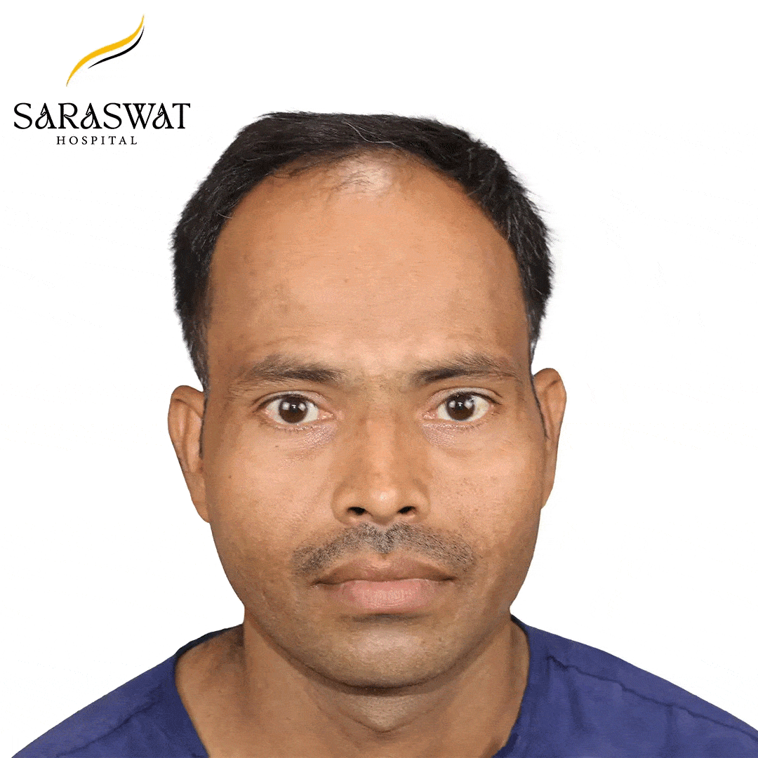 Hair Transplant Before After