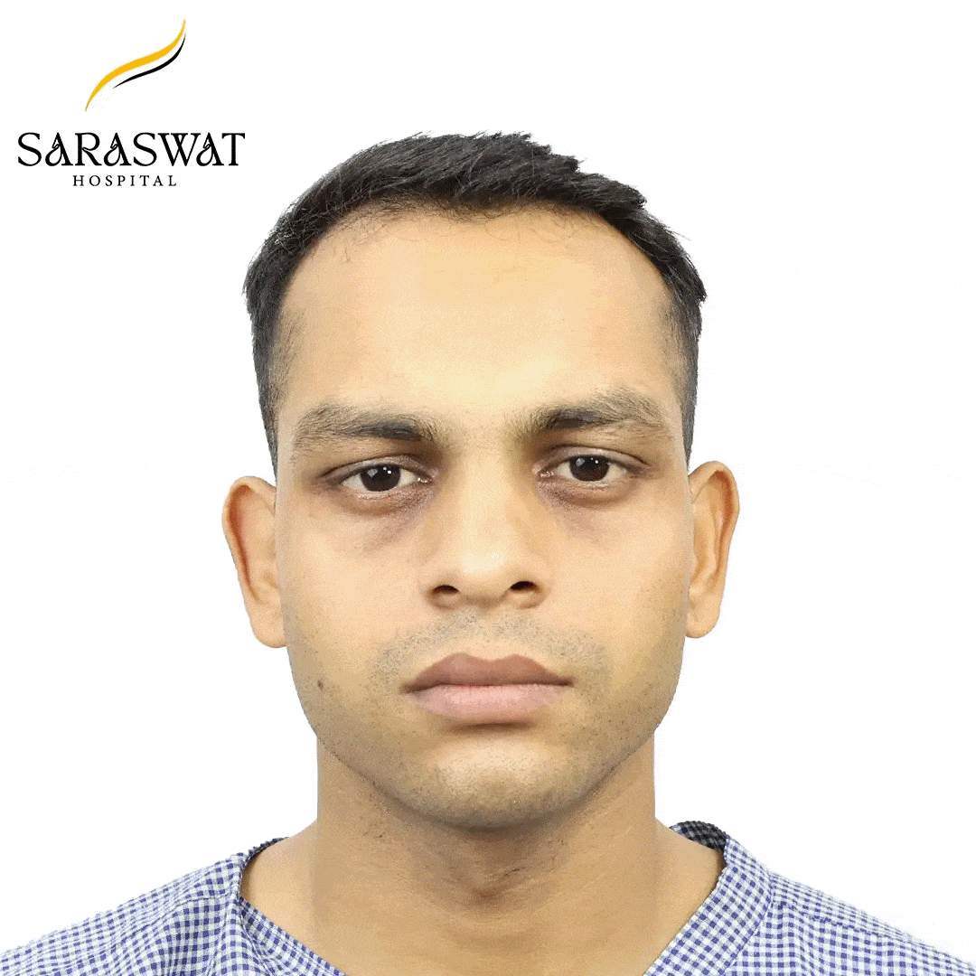 Hair Transplant Before After