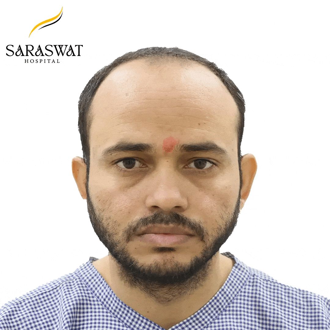 Hair Transplant Before and After