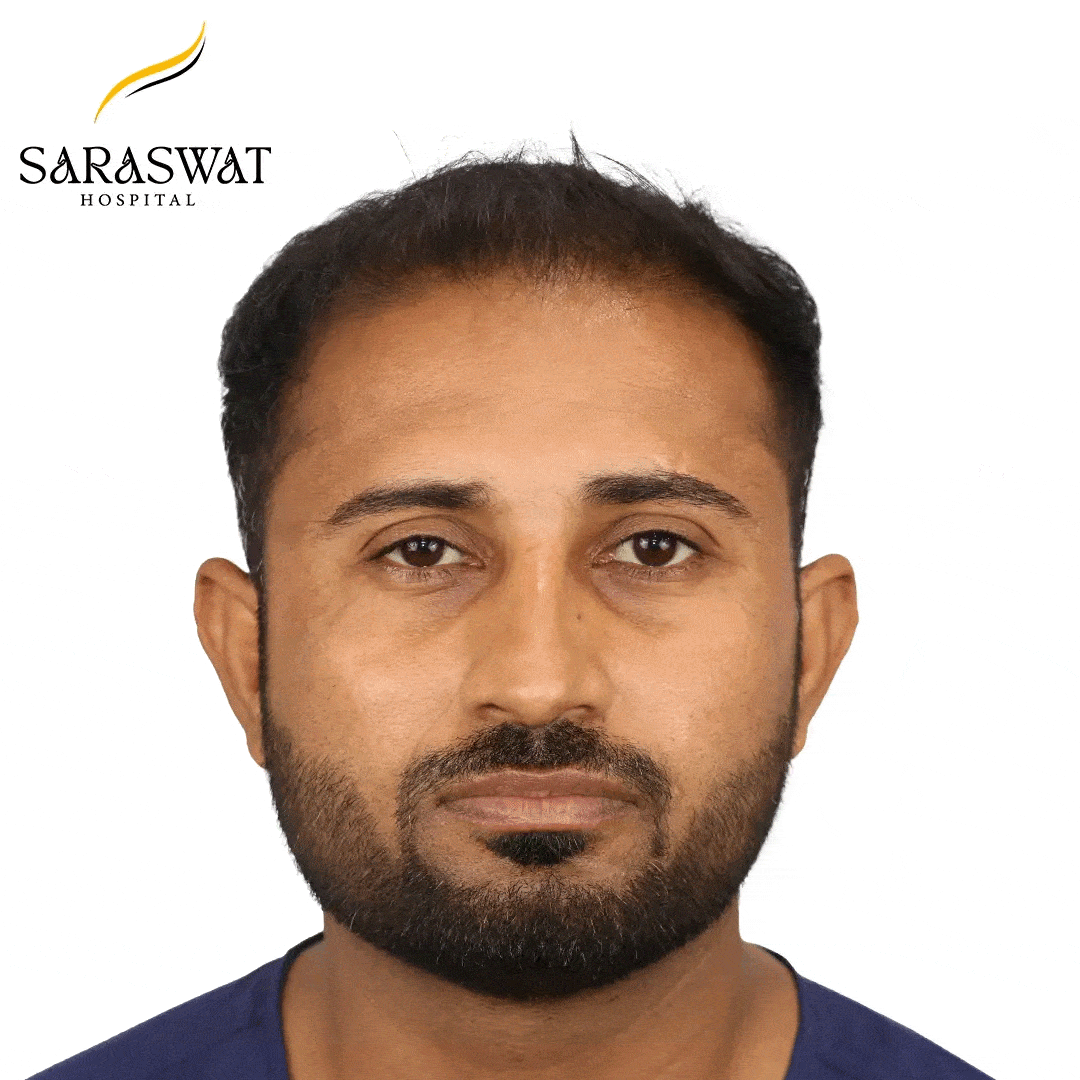 Hair Transplant Before and After Results