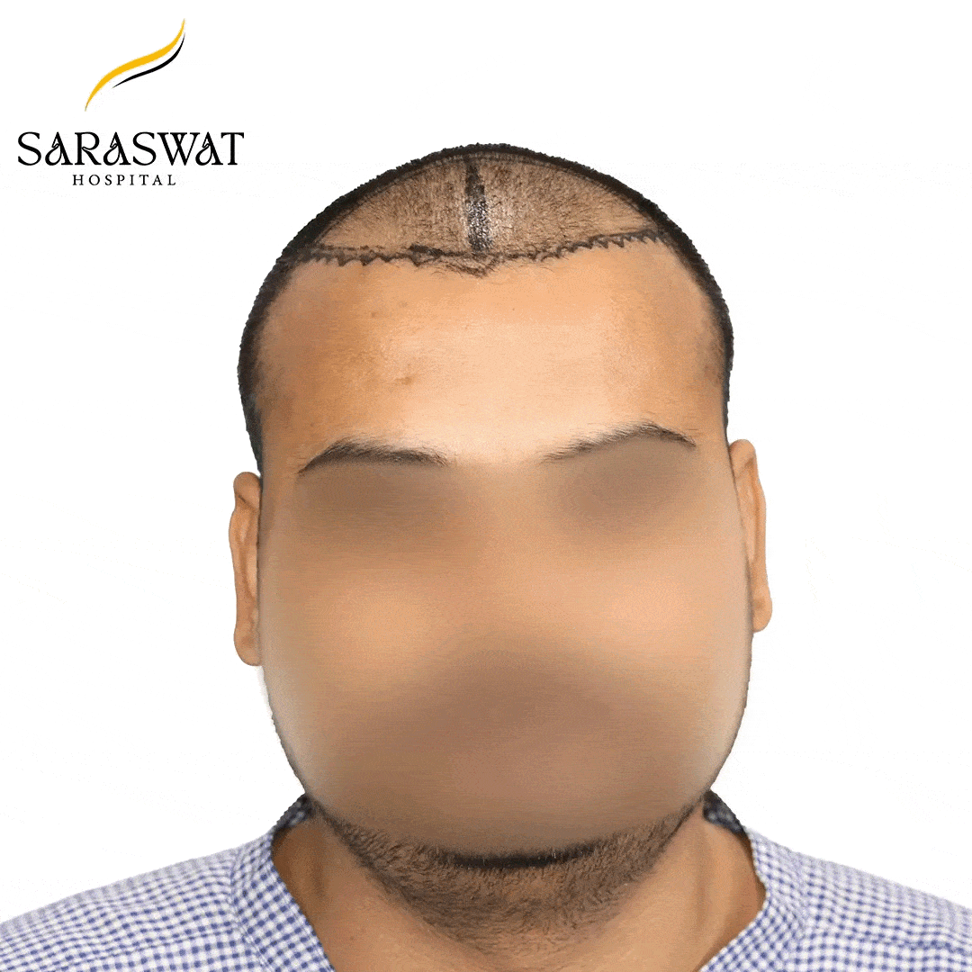 Hair Transplant Before After