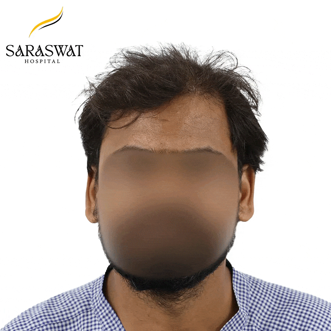 Hair Transplant Before and After Results