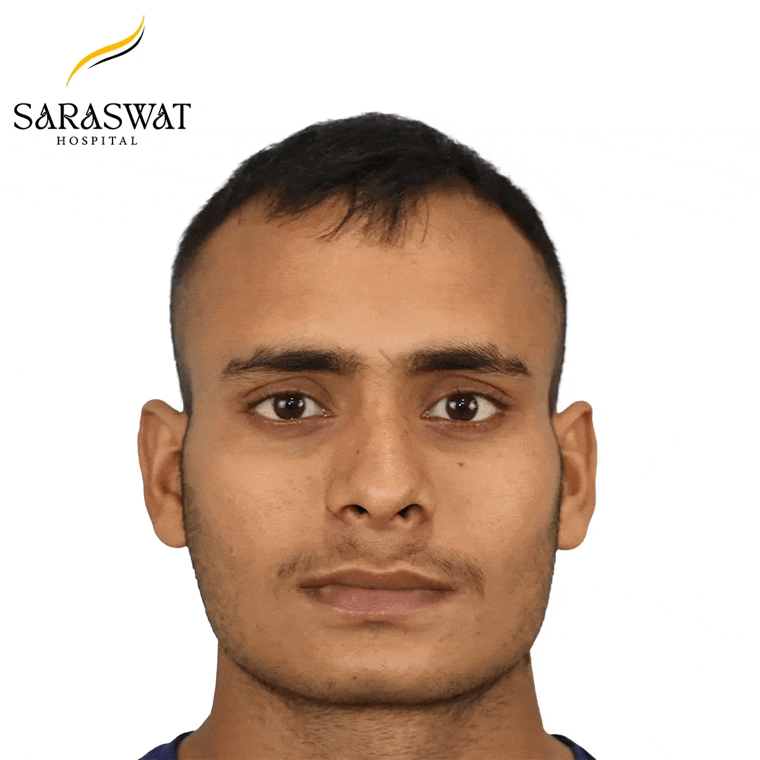 Hair Transplant Before After