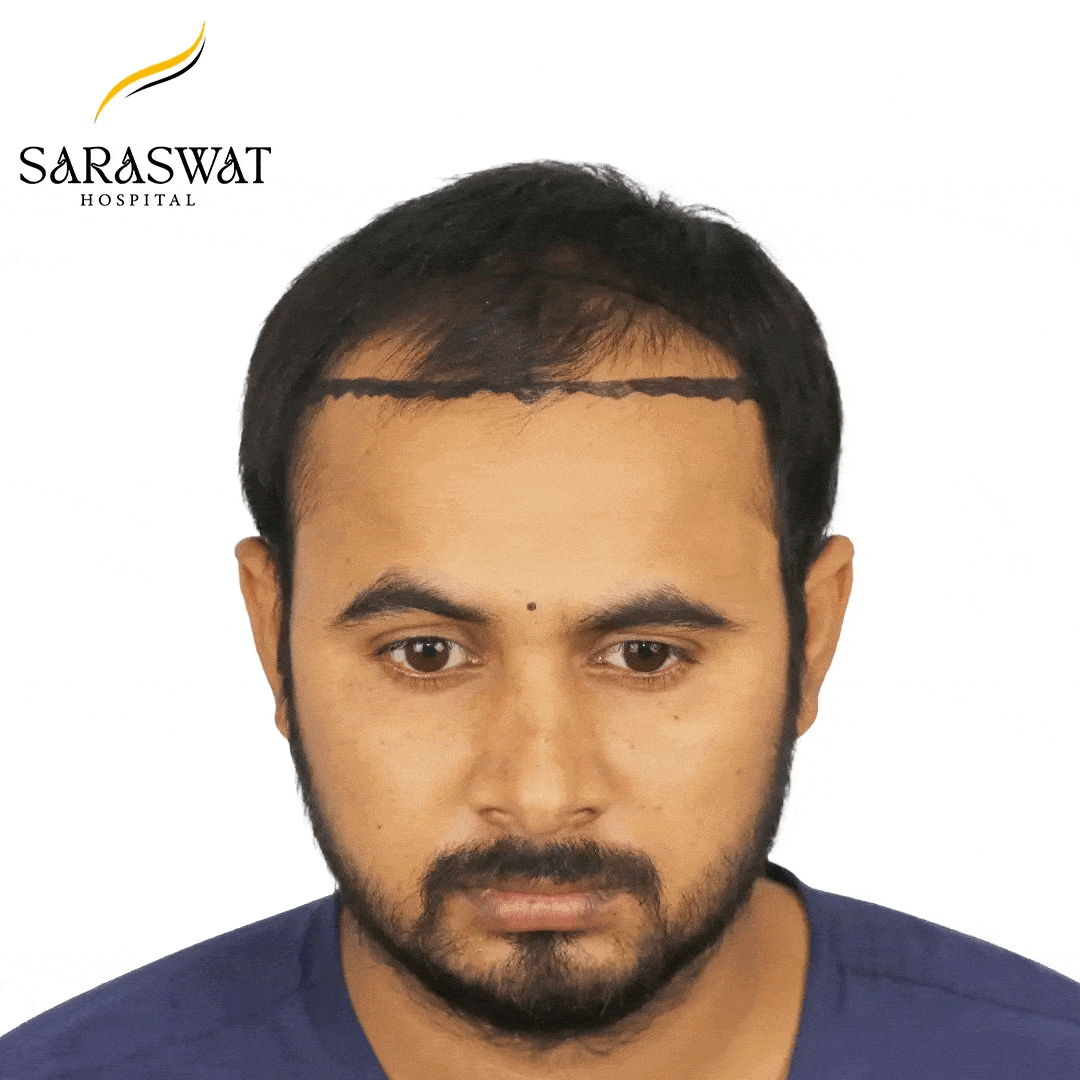 Hair Transplant Before and After Results