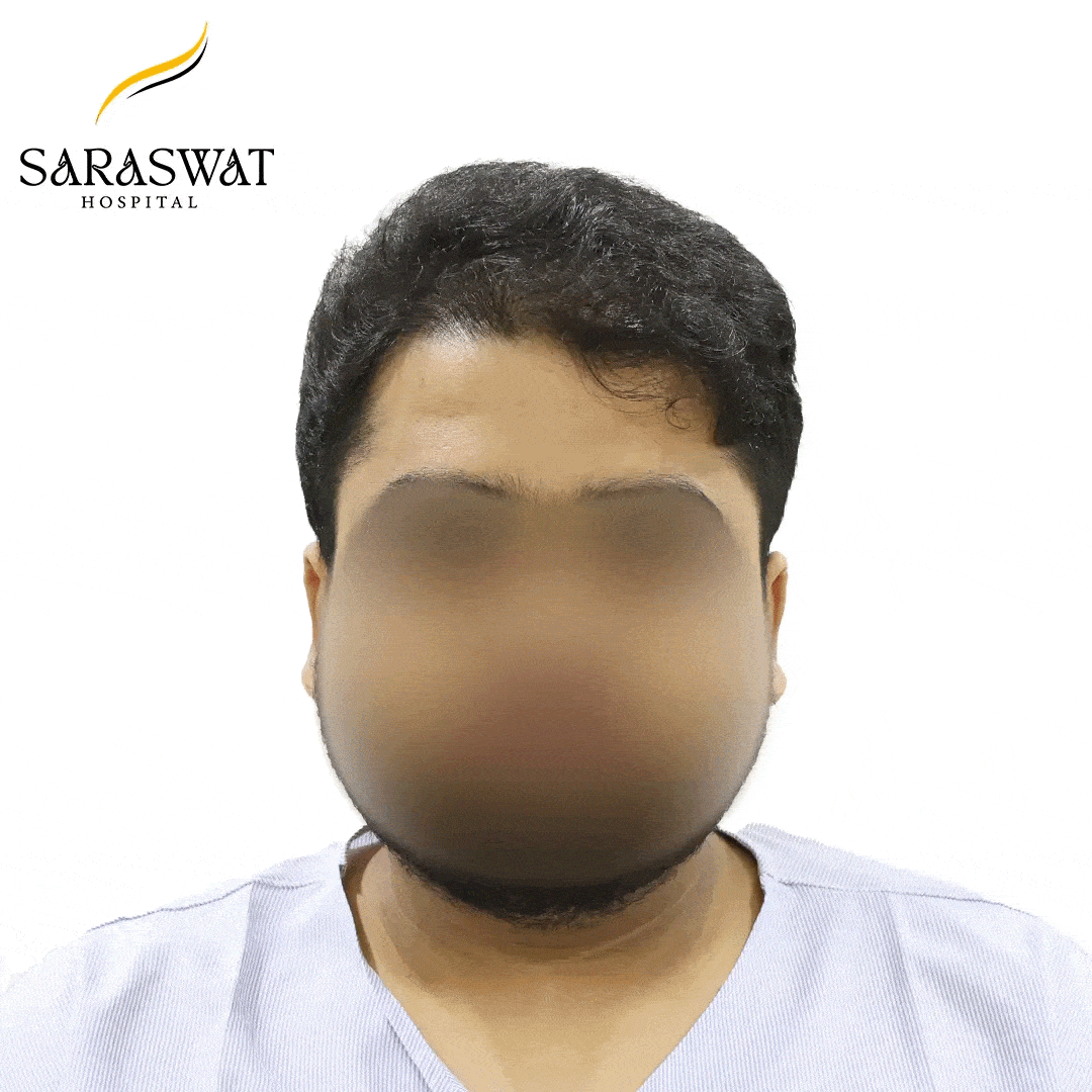 Hair Transplant Before and After Results