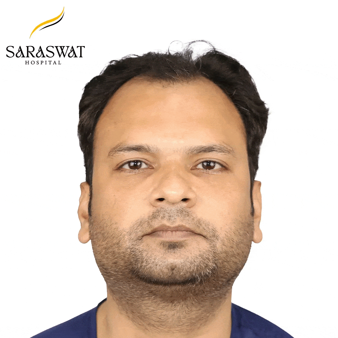 Hair Transplant Before and After Results