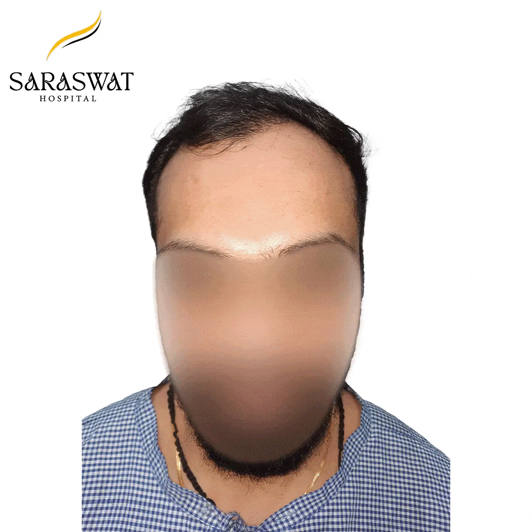 Hair Transplant Before and After