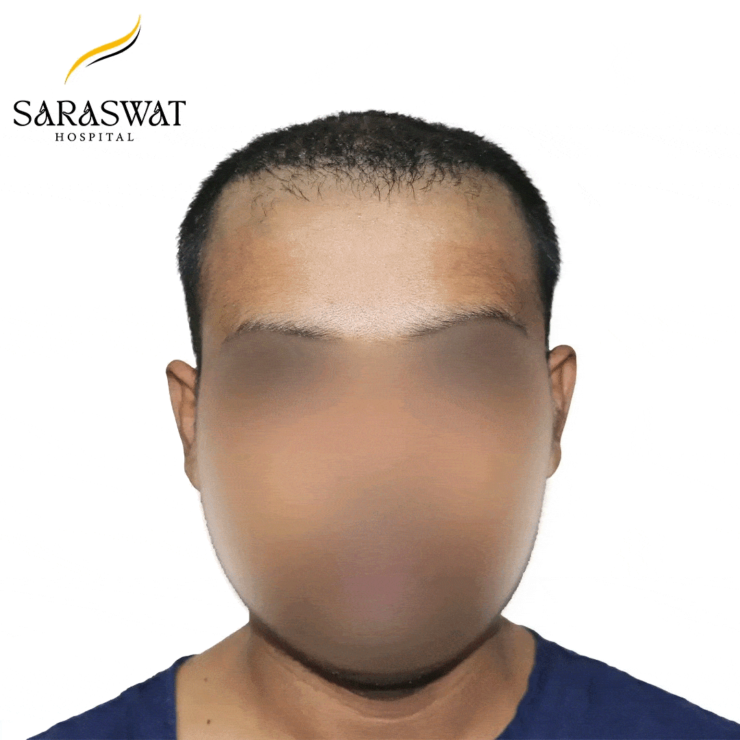 Hair Transplant Before After