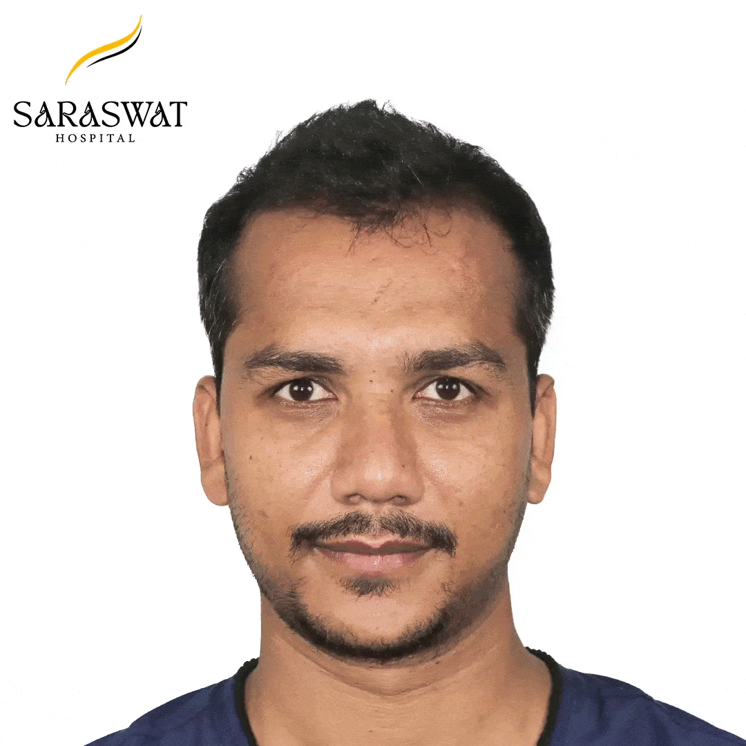 Hair Transplant Before and After