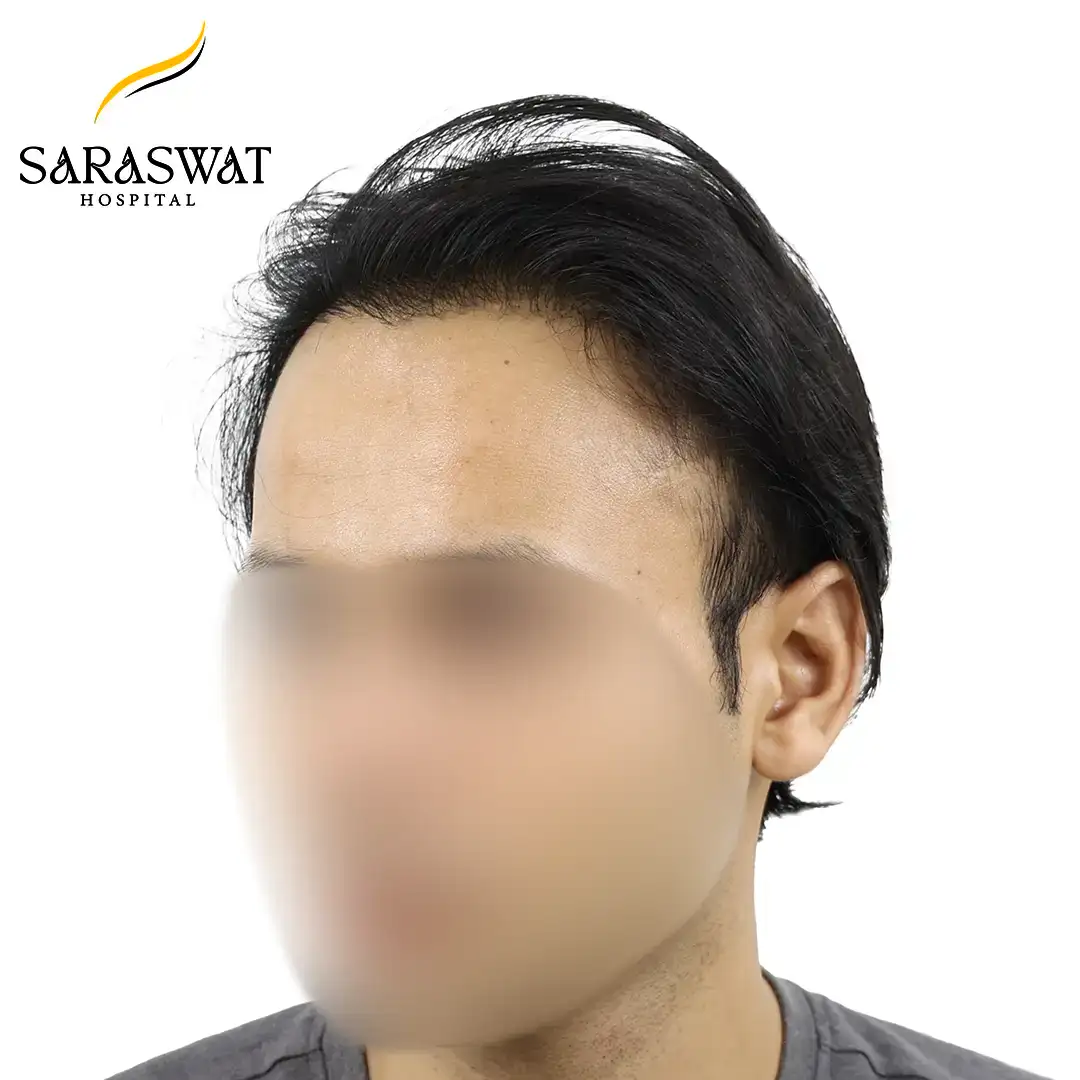 45 Degree Left FUE Hair Transplant Result After Procedure