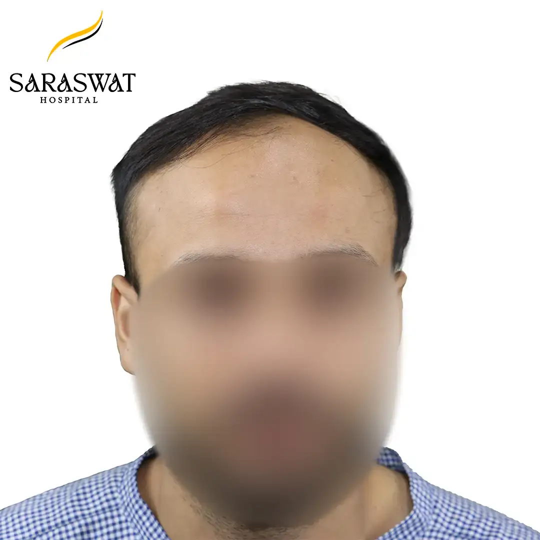 Front FUE Hair Transplant Result Before Procedure