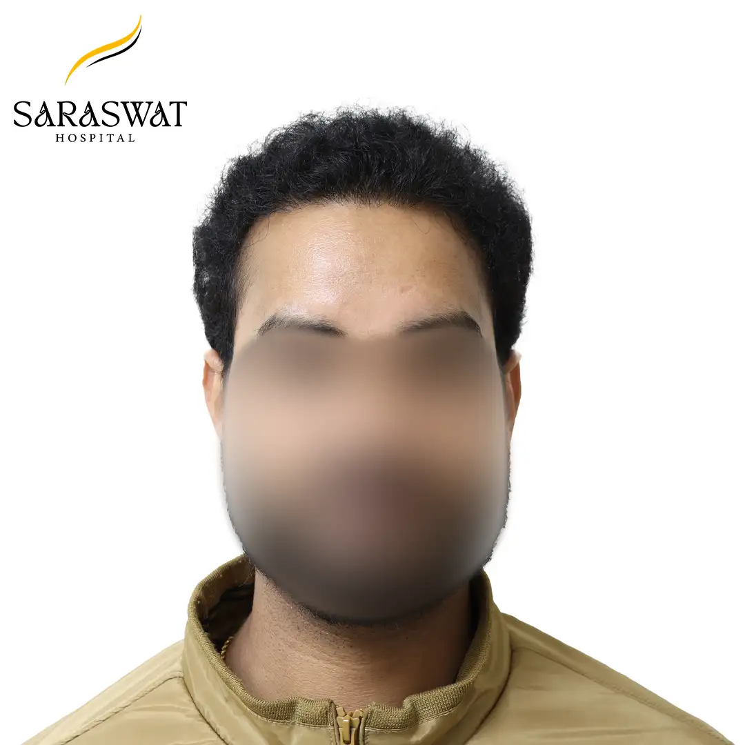 FUE Hair Transplant Result