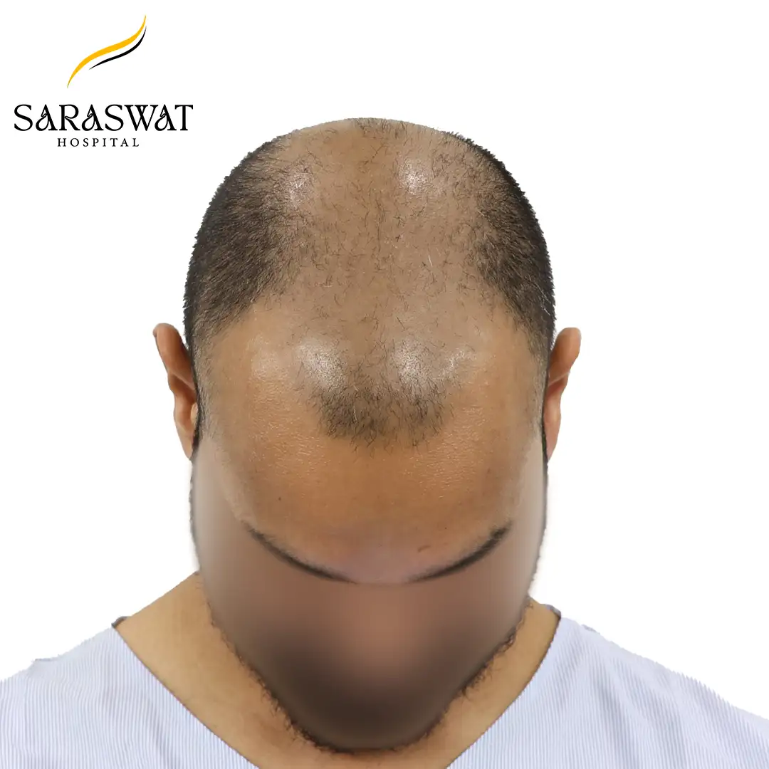Top FUE Hair Transplant Result Before Procedure