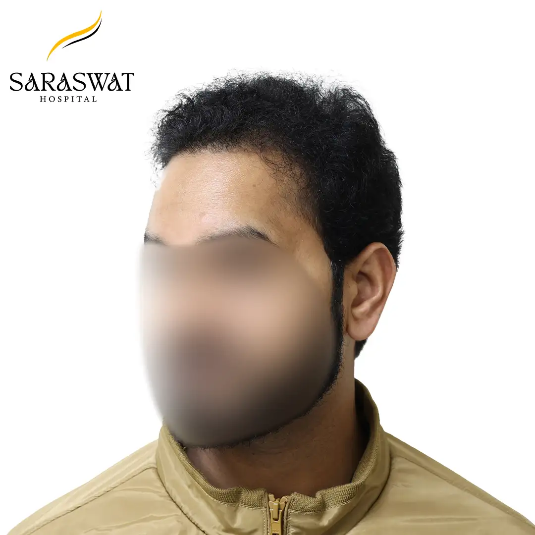 45 Degree FUE Hair Transplant Result After Procedure