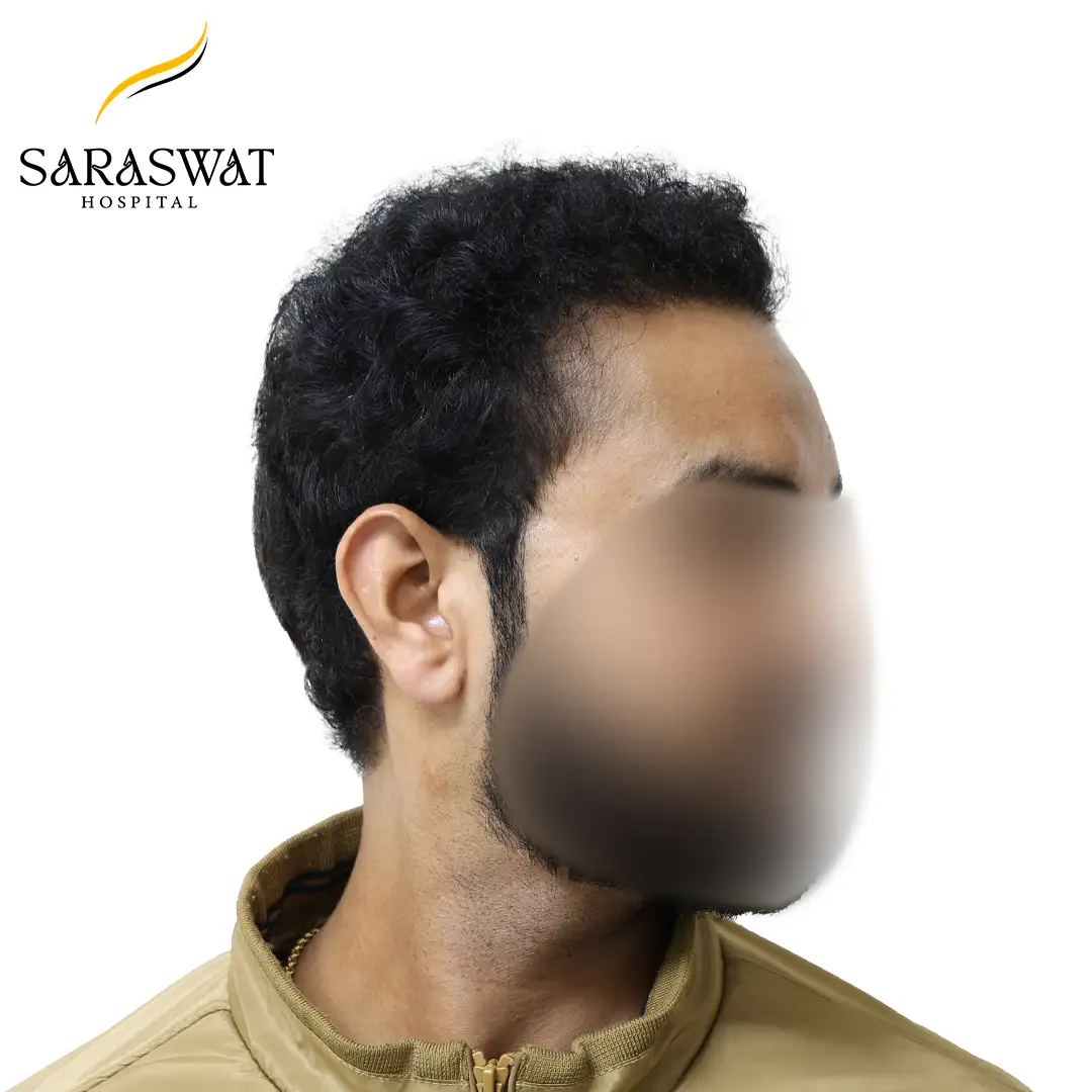 90 Degree FUE Hair Transplant Result After Procedure