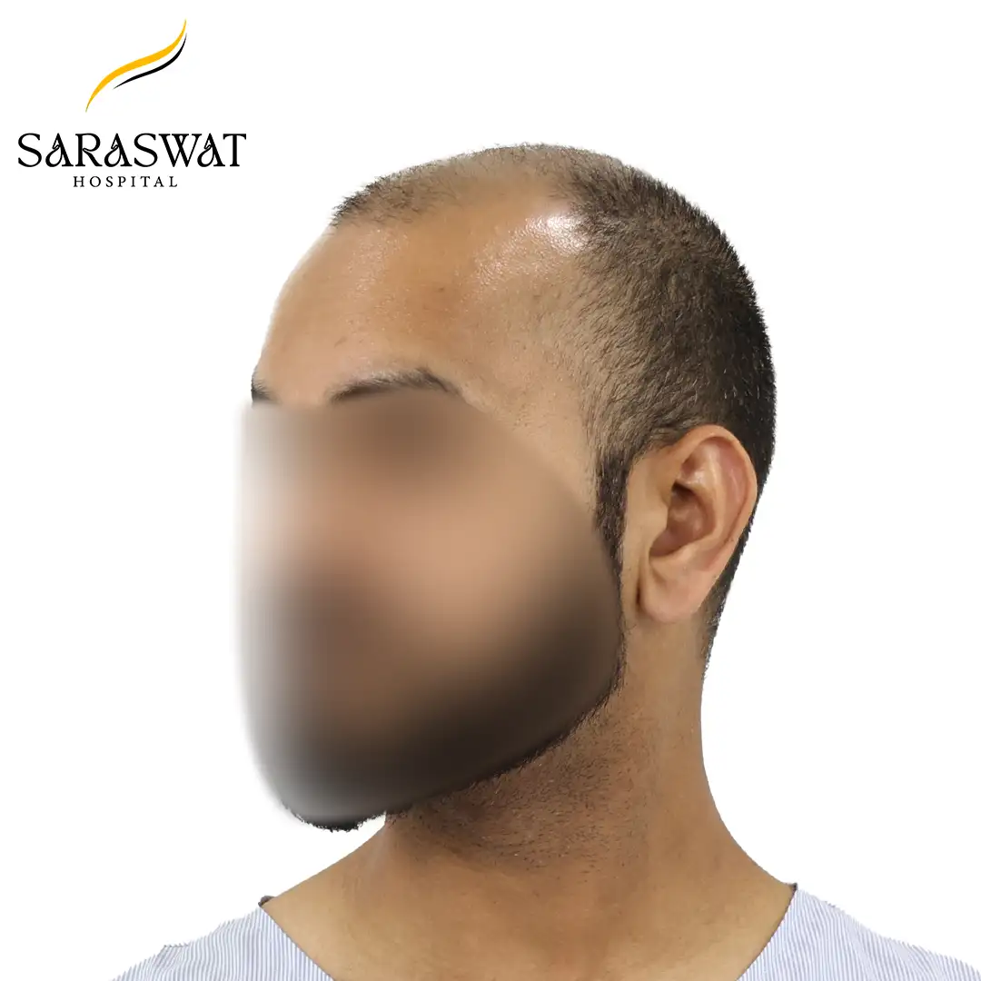 45 Degree FUE Hair Transplant Result Before Procedure