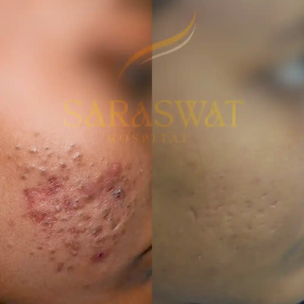 Acne Scar Treatment Results