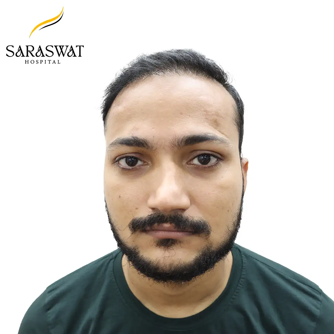 Hair Transplant Result