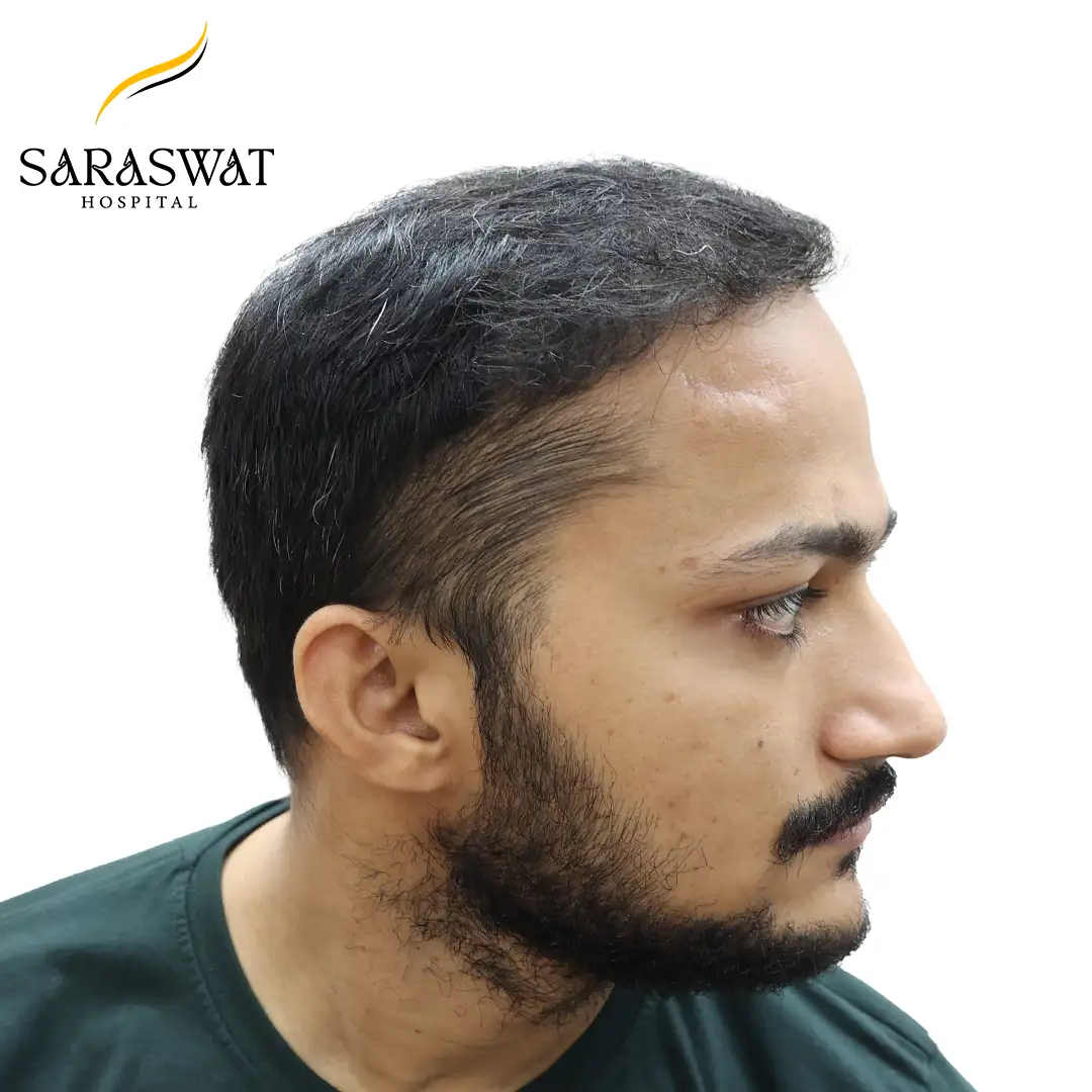Hair Transplant Before and After