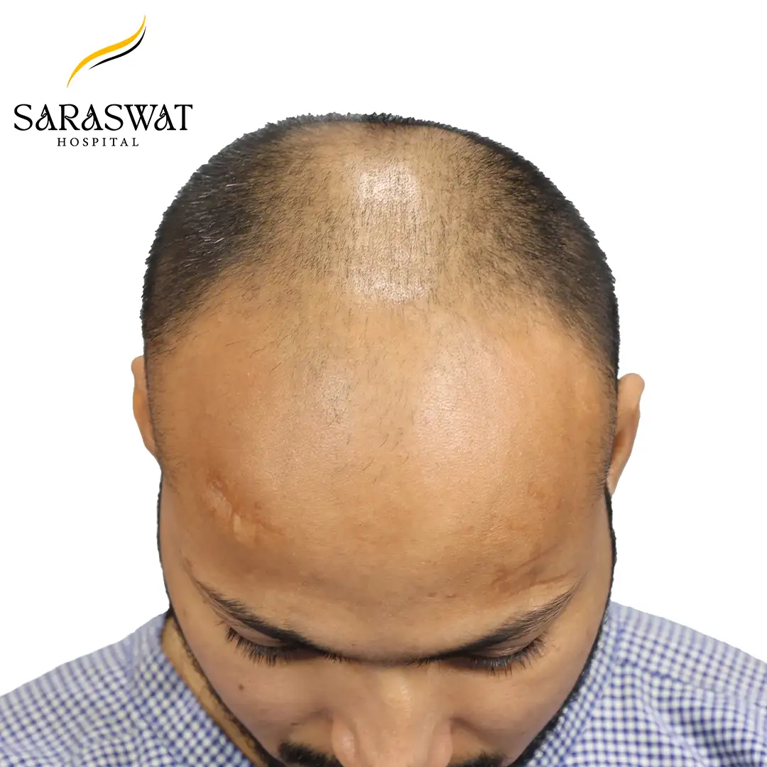 Hair Transplant Result